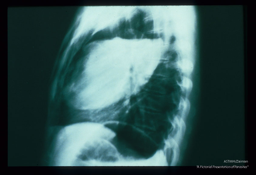 Frontal and lateral chest x-rays. A huge partially empty white cyst is present in the right lung of this patient. It's upper limits are marked by a white pencil-like line of calcium, Above the white fluid and below the white penciled line, the cyst is filled with air (black). This indicates communication between the cyst and a bronchus. Usually an air-fluid interface would be a neat line. In echinococcosis, the line is irregular due to floating collapsed membranes (from the dome of the cyst) and floating daughter cysts. This is the classic floating lily sign of pulmonary echinococcosis.