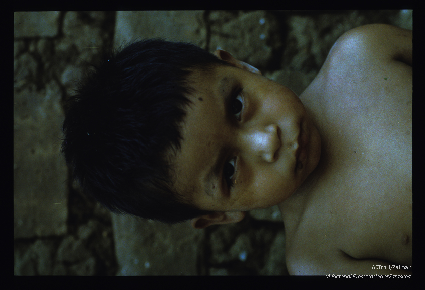 Romana's sign in Chagas'disease. Left periorbital region swollen.