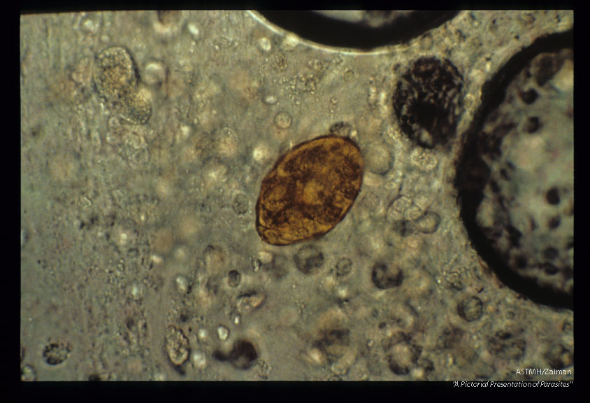 Egg in same sputum.