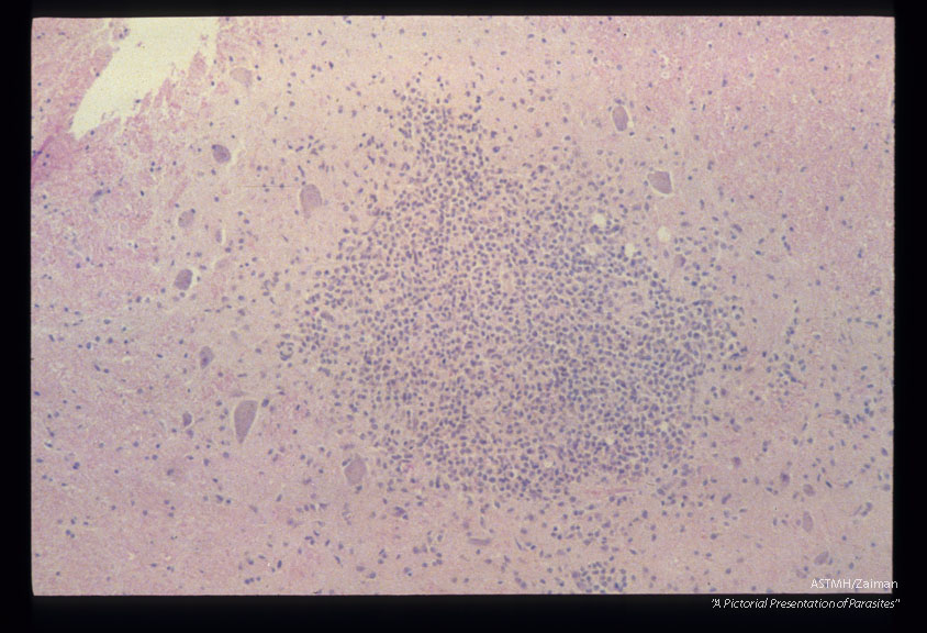 Experimentally infected squirel monkey with inflamed migration track in lateral motor area of cervical spinal cord.