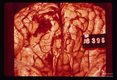 Lee case of primary amoebic meningoencephalitis. Whole brain.