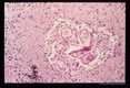 Same case. Larval granuloma in brain.