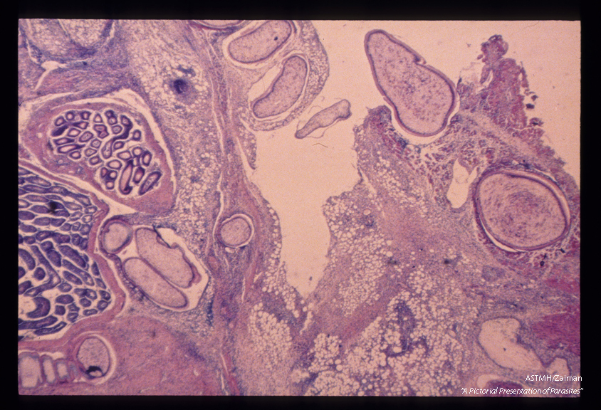 Experimental sparganum infection in a rat. Multiple sections of the parasite are seen within the rat tissues.