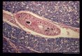 Mesocercaria in the patient's pons.