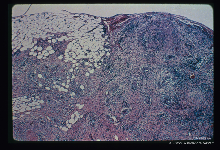 Granulomatous reaction around eggs in mesenteries. A middle aged Puerto Rican female suffering from signs and symptoms of cholecystitis was explored surgically. Gross inspection of the abdomen revealed a thickened mesentery studded with yellow-white granules suggesting metastatic carcinoma. Cholecystectomy was performed. The mesenteric nodules were due to eggs of Schistosoma mansoni.