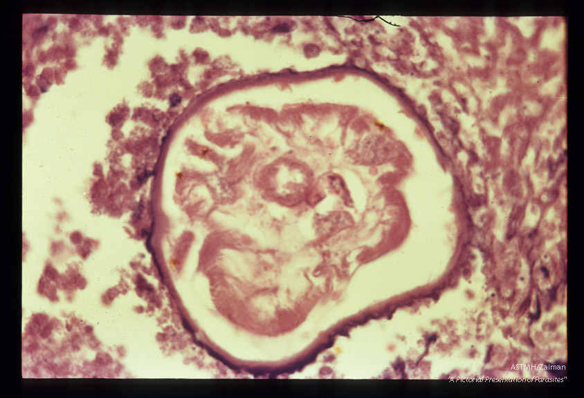 Lung nodule with cross section of filarial nematodes, probably adolescent Dirofilaria.