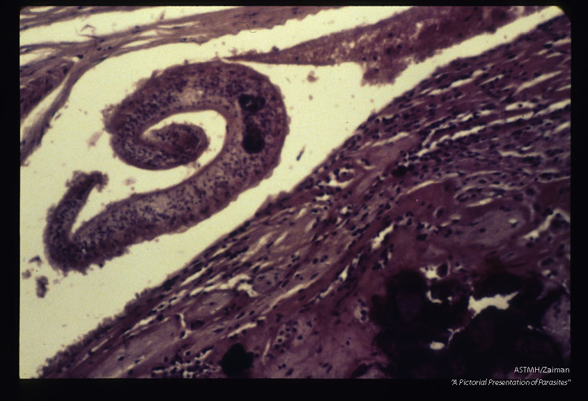 Adult worm within a decidual vessel .