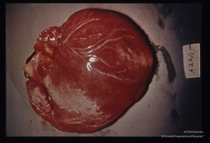 Gross pathology. Unopened heart showing myocarditis in Chagas’ disease.