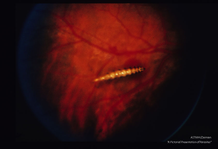 Occular myiasis produced by a first stage larva in the posterior eye chamber of a young male in Tampa, Florida.