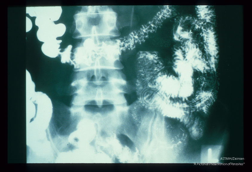 Small bowel barium study shows adult worms which present as longitudinal dark lucencies against the white barium in the small bowel. The worms have ingested the barium. Their guts present as white longitudinal line bisecting the dark lucencies which represent the worm bodies.