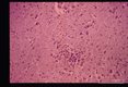 Brain lesions.