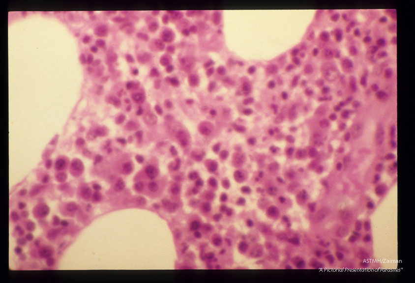 Same case, higher power shows the dense inflammatory response.