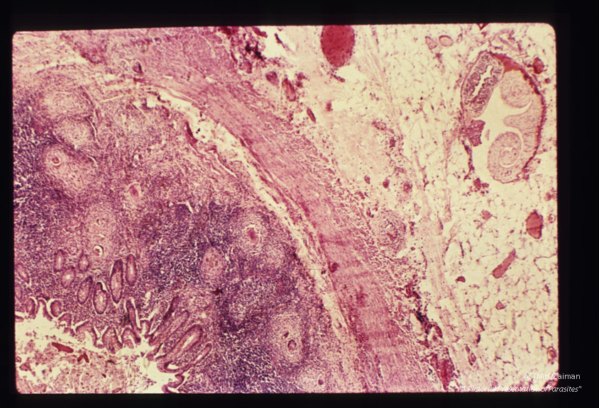 Appendix with adult male and female worms in mesoappendiceal vein and numerous granulomata surrounding ova in the wall.