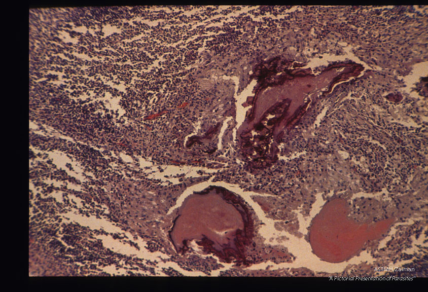 Another case from Holland. Low and high power magnifications of worms in stomach wall. Shows necrotic reaction around larva in an eosinophilic granuloma later in infection (4 months).