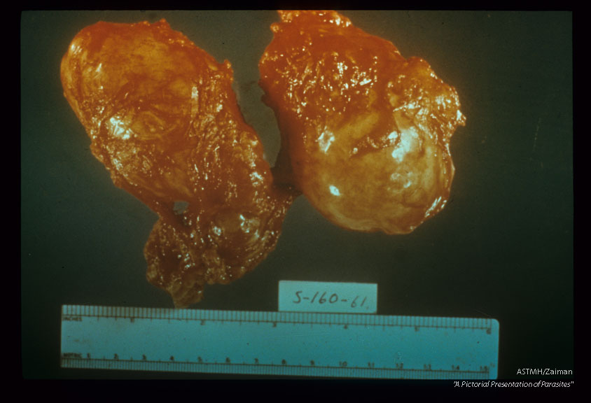 Cyst in kidney.