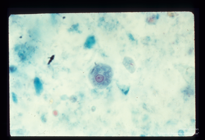 Trophozoite. The karyosome is small, slightly eccentric (in spite of the textbooks) and the nuclear chromatin is a fine even line.