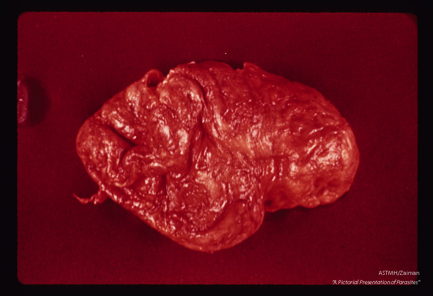 Whole brain showing severe inflammatory reaction of meninges. Thinning of the cortex can be observed in region where the brain was incised.