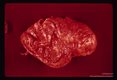 Whole brain showing severe inflammatory reaction of meninges. Thinning of the cortex can be observed in region where the brain was incised.