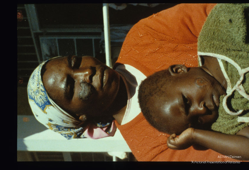 Diffuse cutaneous leishmaniasis. Facial lesions on mother and child.