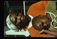 Diffuse cutaneous leishmaniasis. Facial lesions on mother and child.