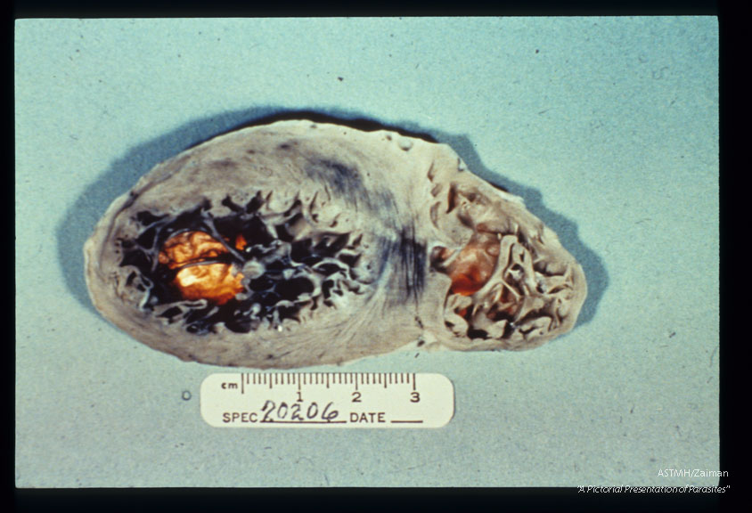 Multiple specimens showing aneurysmal dilatation and thinning of the apical myocardium, plus marked concentric muscular hypertrophy. Light is transmitted through the thinned muscle.