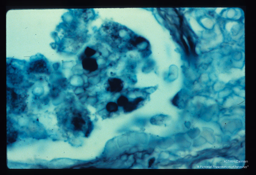 Pneumonia. High powered view of infected lung designed to illustrate dark staining nucleus and parasite wall by silver methenamine technique.