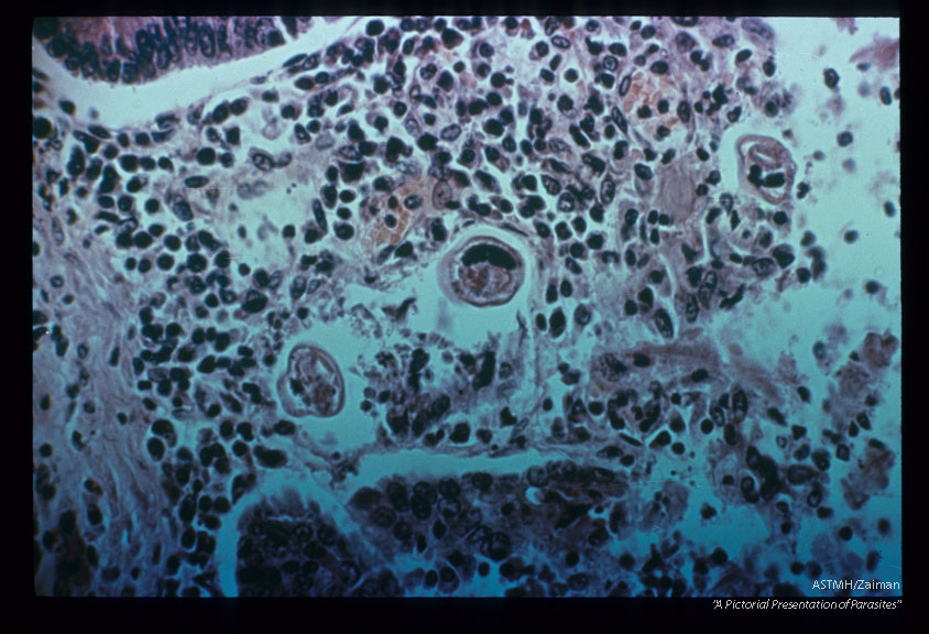 Same case. Portion of adult.