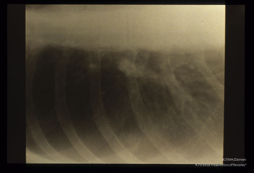 Peripheral nodule seen in chest x-ray.