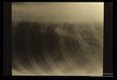 Peripheral nodule seen in chest x-ray.