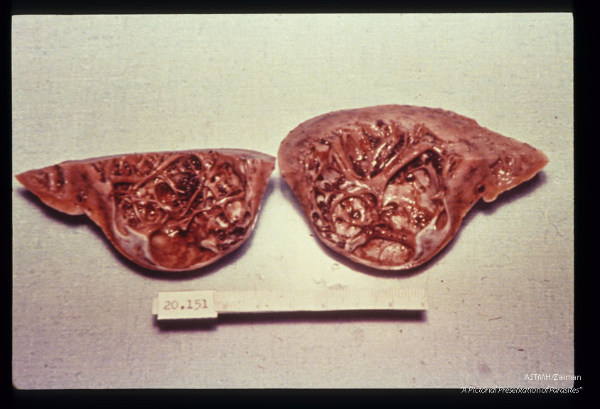 Multiple specimens showing aneurysmal dilatation and thinning of the apical myocardium, plus marked concentric muscular hypertrophy.