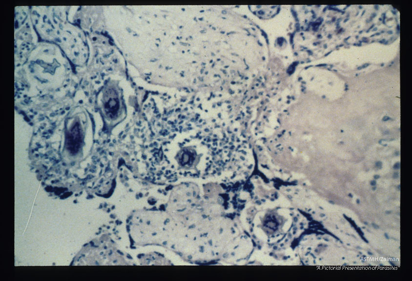 Schistosomal placentitis. Intervillous space and villi showing eggs within granulomata.