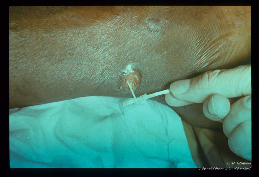 Extracting worms by classical match stick technique.