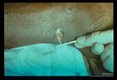 Extracting worms by classical match stick technique.