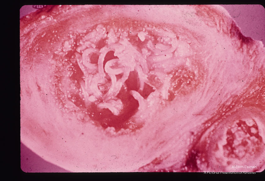 Sectioned nodule showing adult nernatodes.