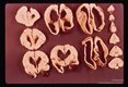 Coronal sections of same brain showing dilatation of ventricles and thinning of cortex as well as hemorrhage.