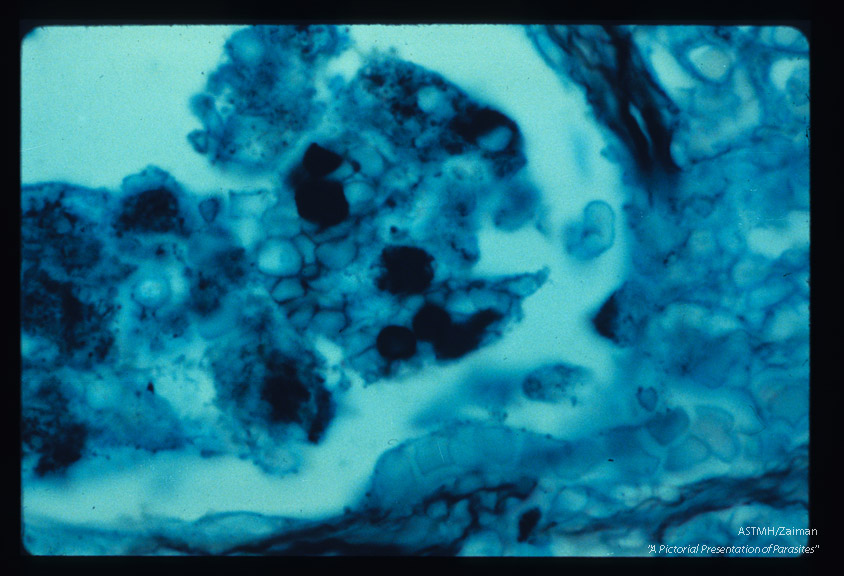 Pneumonia. High powered view of infected lung designed to illustrate dark staining nucleus and parasite wall by silver methenamine technique.