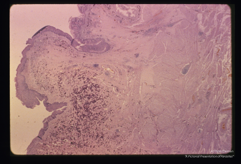 Polyp formation and squamous cell metaplasia in a human urinary bladder heavily infiltrated with ova.