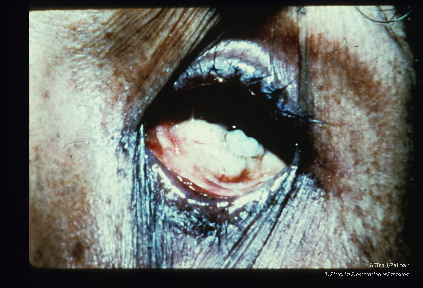 Eye destruction in a Mexican patient who suffered the disease for 13 years.