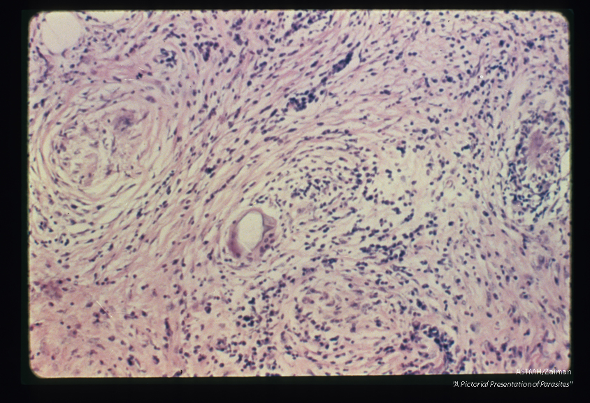 Egg in mesenteric granuloma. A single lateral spined ovum is seen in a fairly fibrous granuloma.