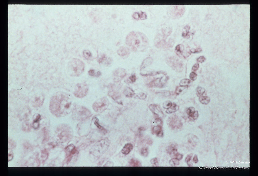 Meningitis- Hematoxylin-eosin stained section of human brain at various magnifications.