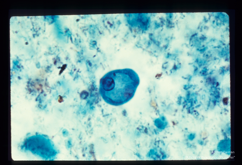 Precystic form. Iron hematoxylin stain. A single nucleus and a large pale giycogen vacuole are present. These forms are very similar to those which might be present in similar stages of E. histolytica and should not be used for diagnosis.