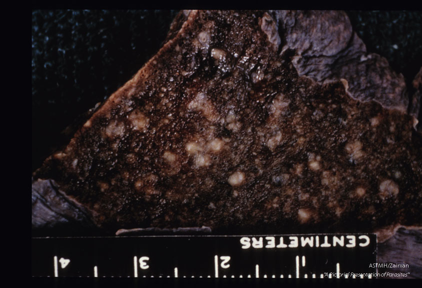 Gross pathology. Lung slices showing pseudotubercles in fatal pulmonary schistosomiasis.