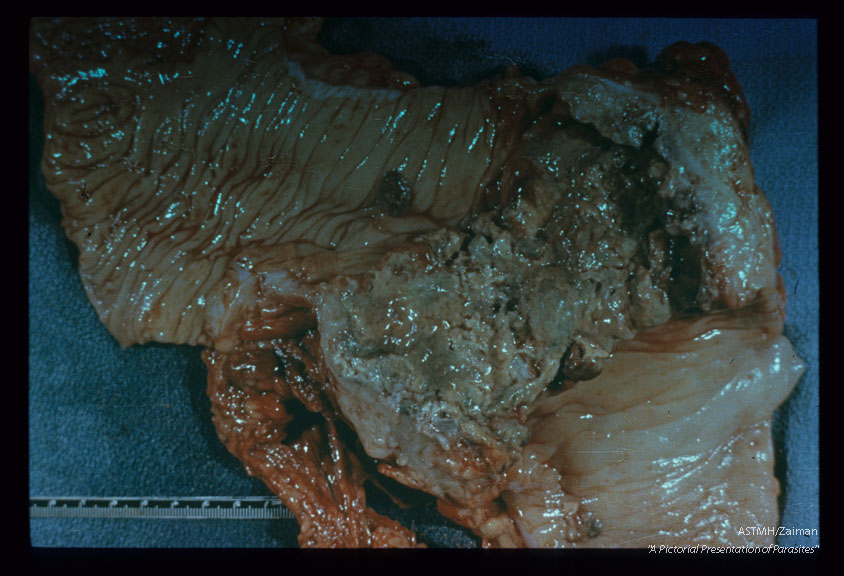 Adults woven into mucosa of 22 yr. old Chinese female. Ulcerating carcinoma seen in lower power photographs.