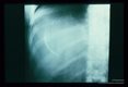 A cyst present in the upper portion of the right lobe of the liver is poorly calcified and presents only as a circumlinear white line.