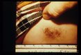 Evolution of dermatitis produced by venom introduced into human skin by hollow larval poisonous spines. Five days after exposure.