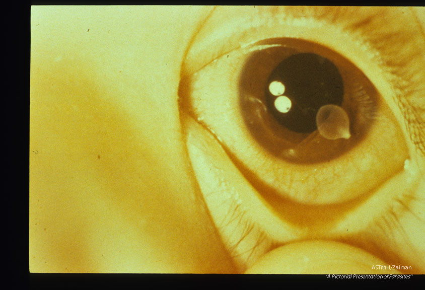 Cysticercus in eye.