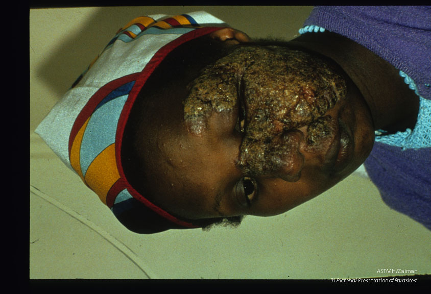 Diffuse cutaneous leishmaniasis. Facial lesion.