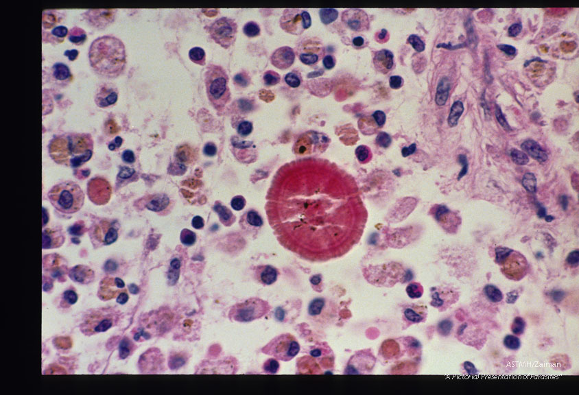 Leisegang rings have been mistaken for eggs of the giant kidney worm Dioctophvma renale by multiple authors. They are periodic precipitation zones formed from supersaturated solutions in colloidal systems. These slides are from one such case.