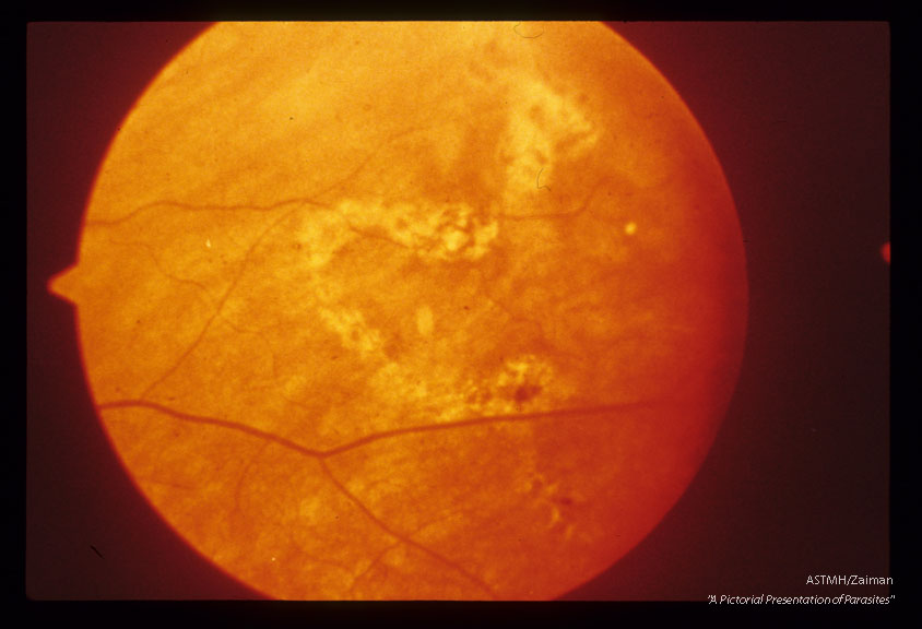 In human eye. Part of pigmented track resulting from migration of trematode.