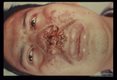 (South America). One year old infection with involvement of nasal structures.